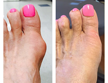 Bunion surgery