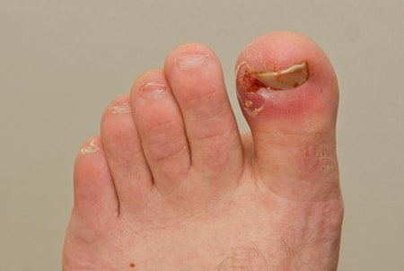 Ingrown Toe Nails