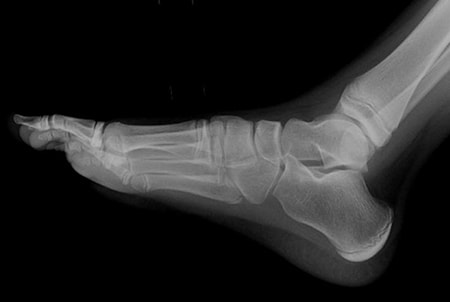 Xray Foot