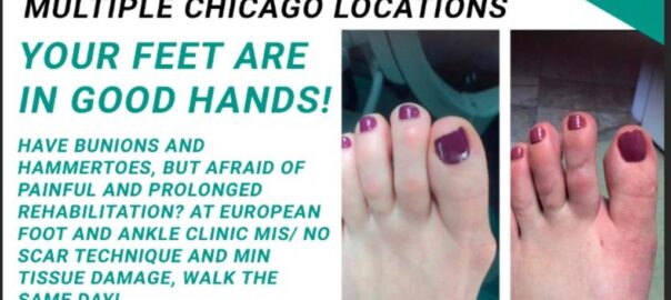 Bunion surgery