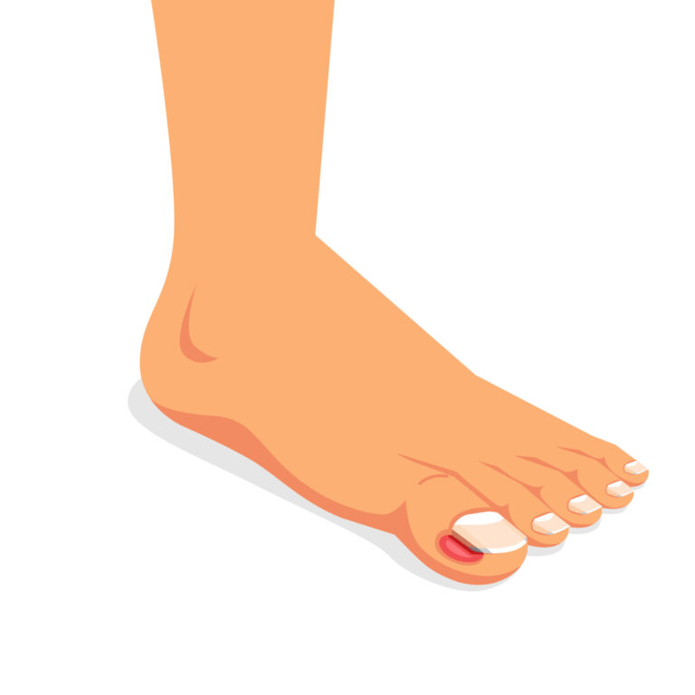 Ingrown Toenails treatment