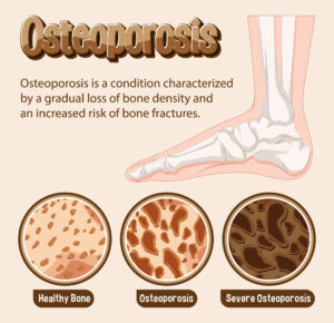 Osteoporosis in feet