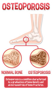 Foot Osteoporosis